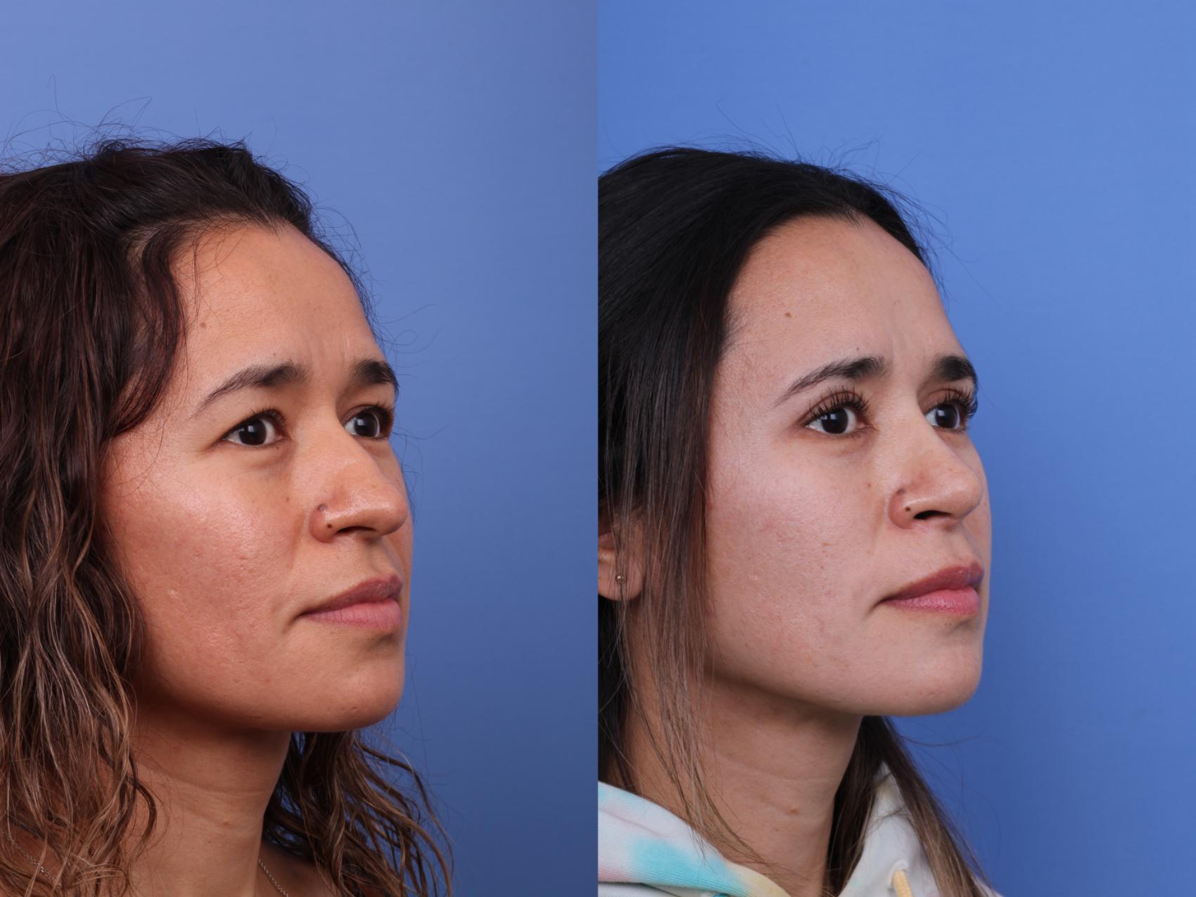 Blepharoplasty Before & After Photo | Scottsdale & Phoenix, AZ | Hobgood Facial Plastic Surgery: Todd Hobgood, MD