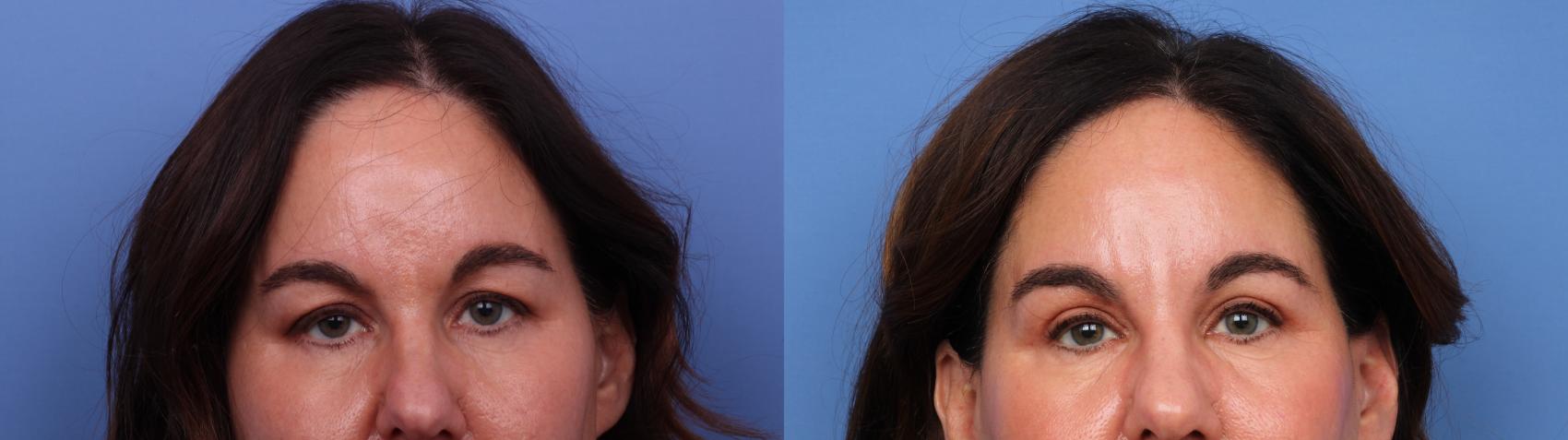 Blepharoplasty Before & After Photo | Scottsdale & Phoenix, AZ | Hobgood Facial Plastic Surgery: Todd Hobgood, MD