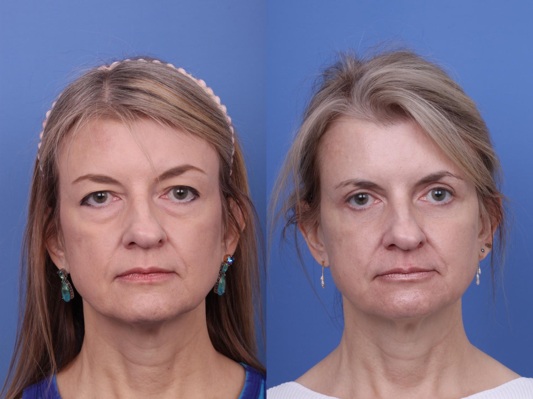 Blepharoplasty Before & After Photo | Scottsdale & Phoenix, AZ | Hobgood Facial Plastic Surgery: Todd Hobgood, MD