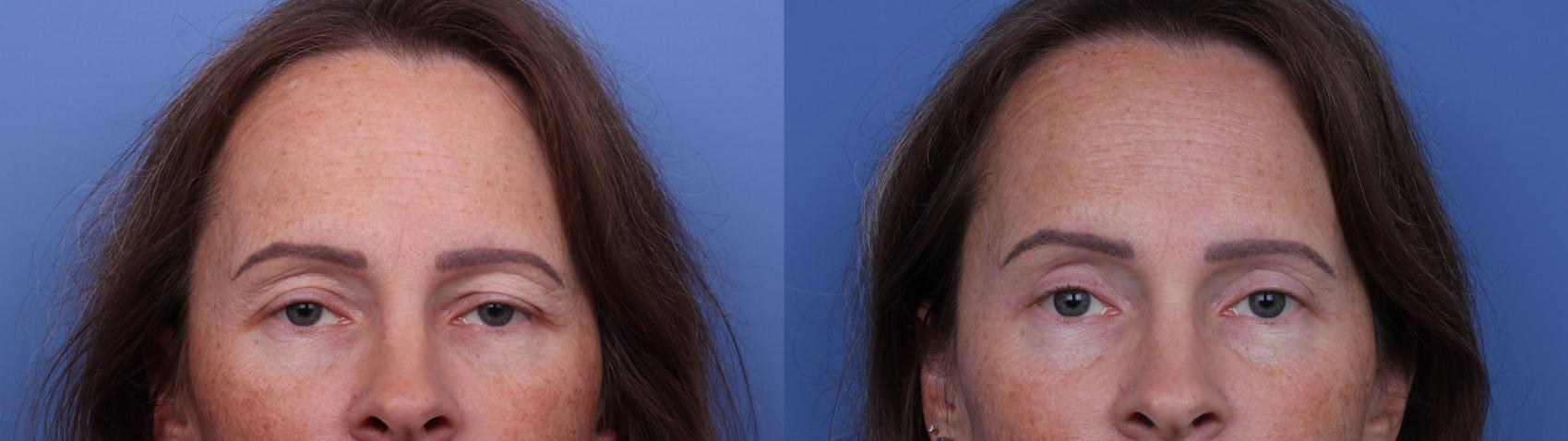 Blepharoplasty Before & After Photo | Scottsdale & Phoenix, AZ | Hobgood Facial Plastic Surgery: Todd Hobgood, MD