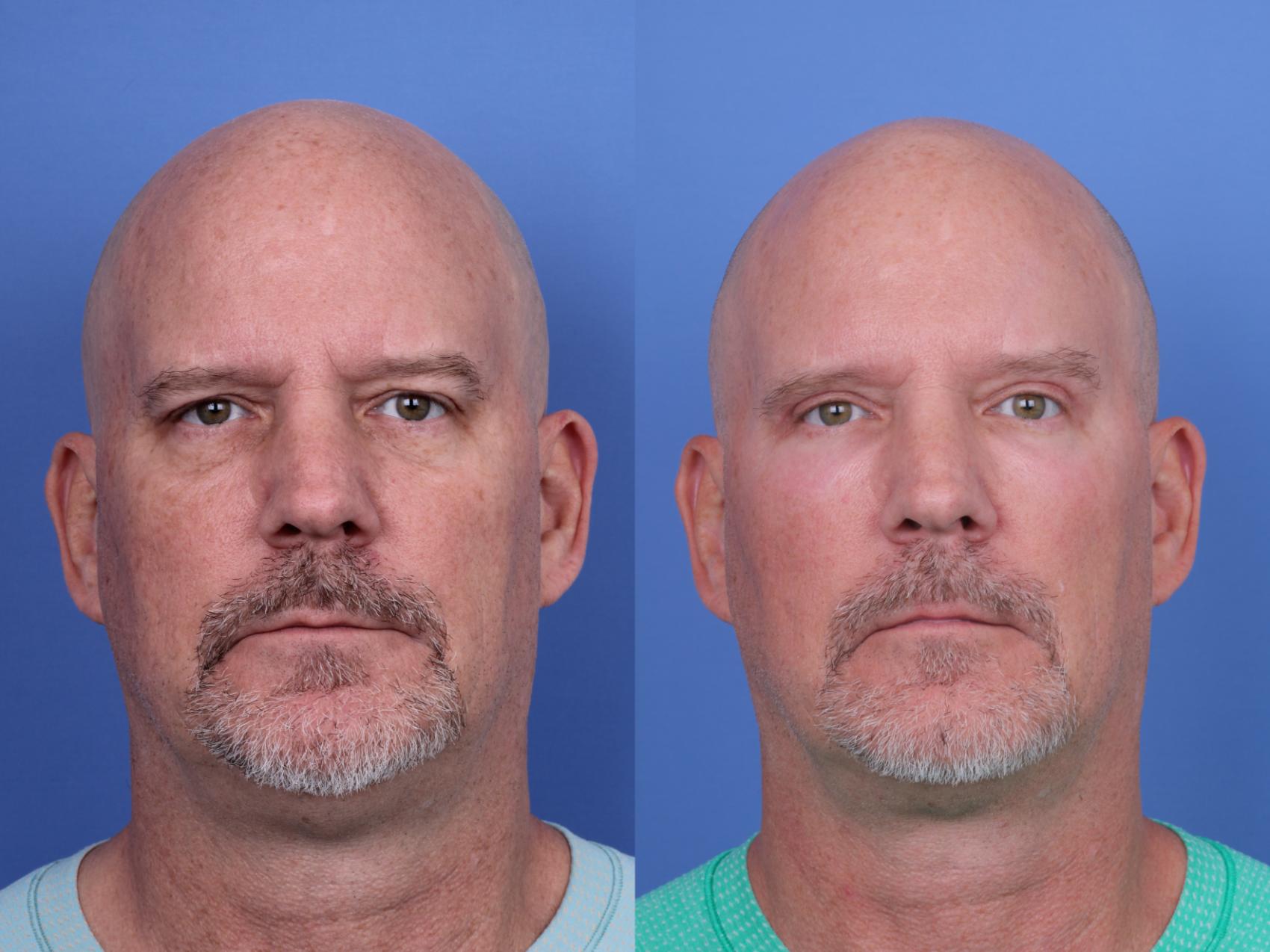 Blepharoplasty Before & After Photo | Scottsdale & Phoenix, AZ | Hobgood Facial Plastic Surgery: Todd Hobgood, MD