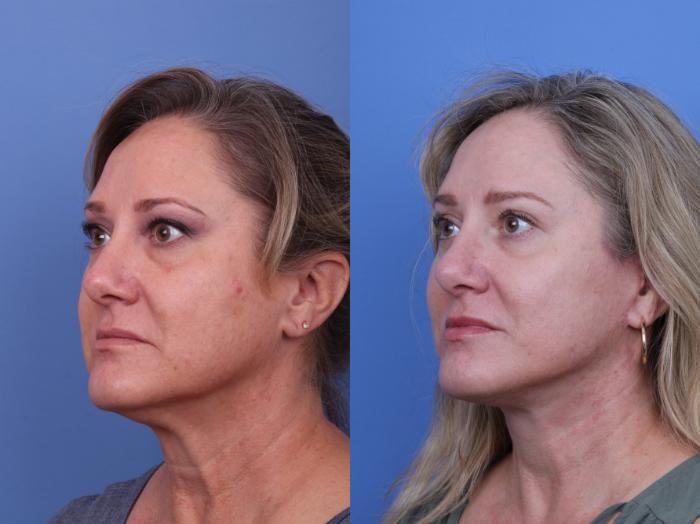 CO2 Laser Resurfacing (under anesthesia) Before & After Photo | Scottsdale & Phoenix, AZ | Hobgood Facial Plastic Surgery: Todd Hobgood, MD