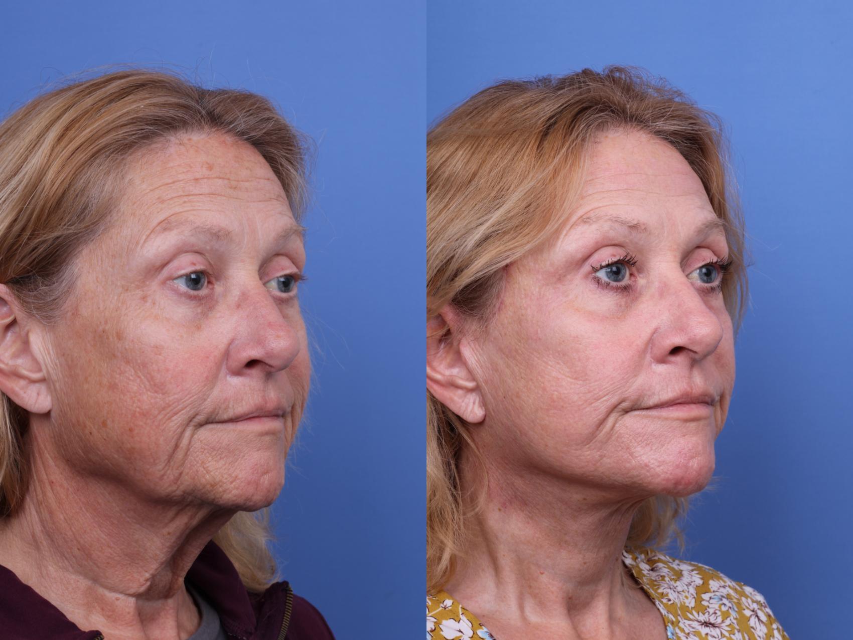 Facelift Before & After Photo | Scottsdale & Phoenix, AZ | Hobgood Facial Plastic Surgery: Todd Hobgood, MD