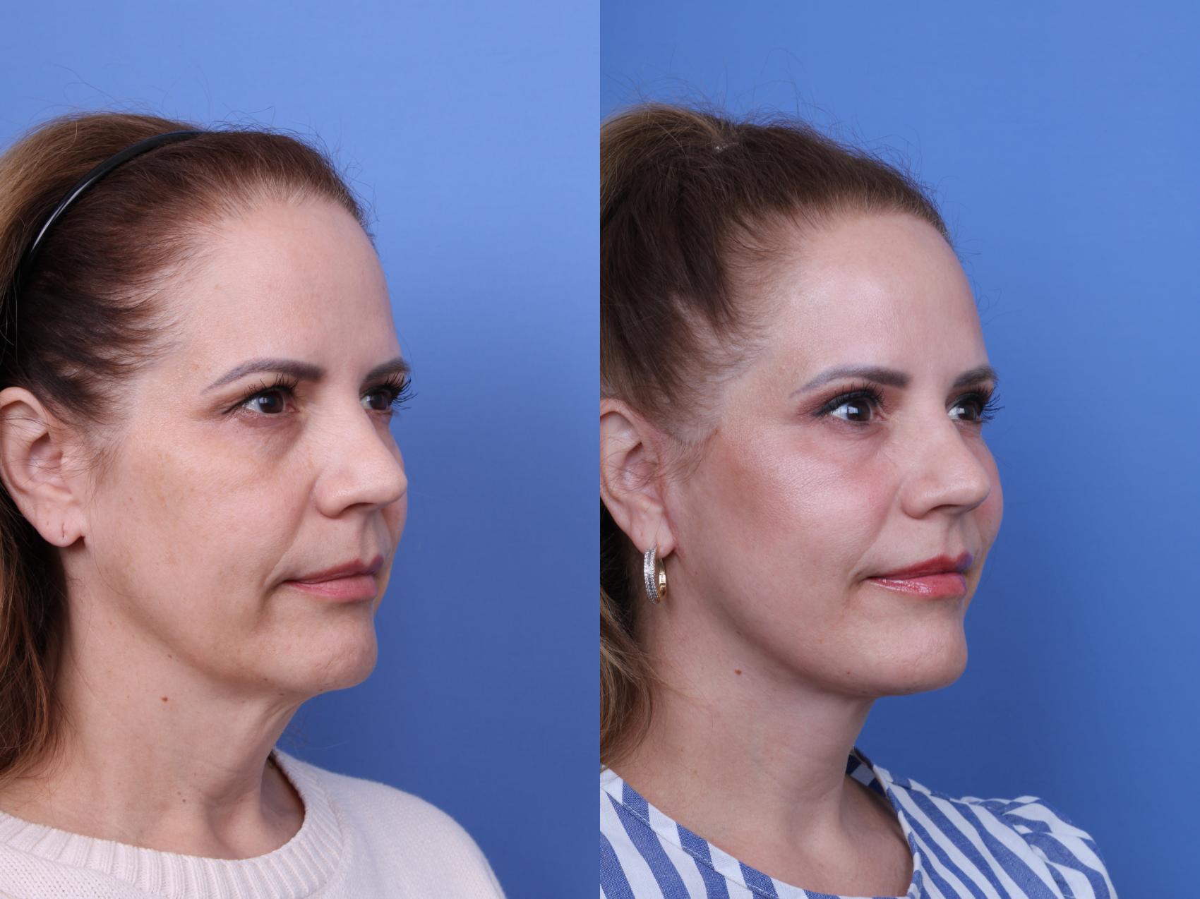 Facelift Before & After Photo | Scottsdale & Phoenix, AZ | Hobgood Facial Plastic Surgery: Todd Hobgood, MD