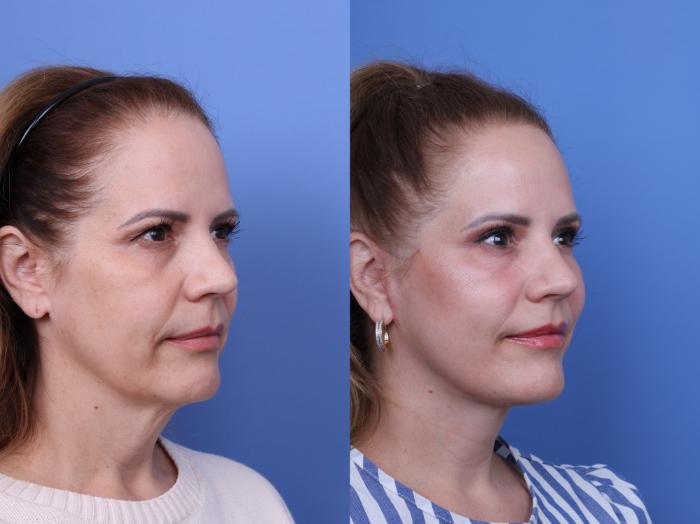 CO2 Laser Resurfacing (under anesthesia) Before & After Photo | Scottsdale & Phoenix, AZ | Hobgood Facial Plastic Surgery: Todd Hobgood, MD