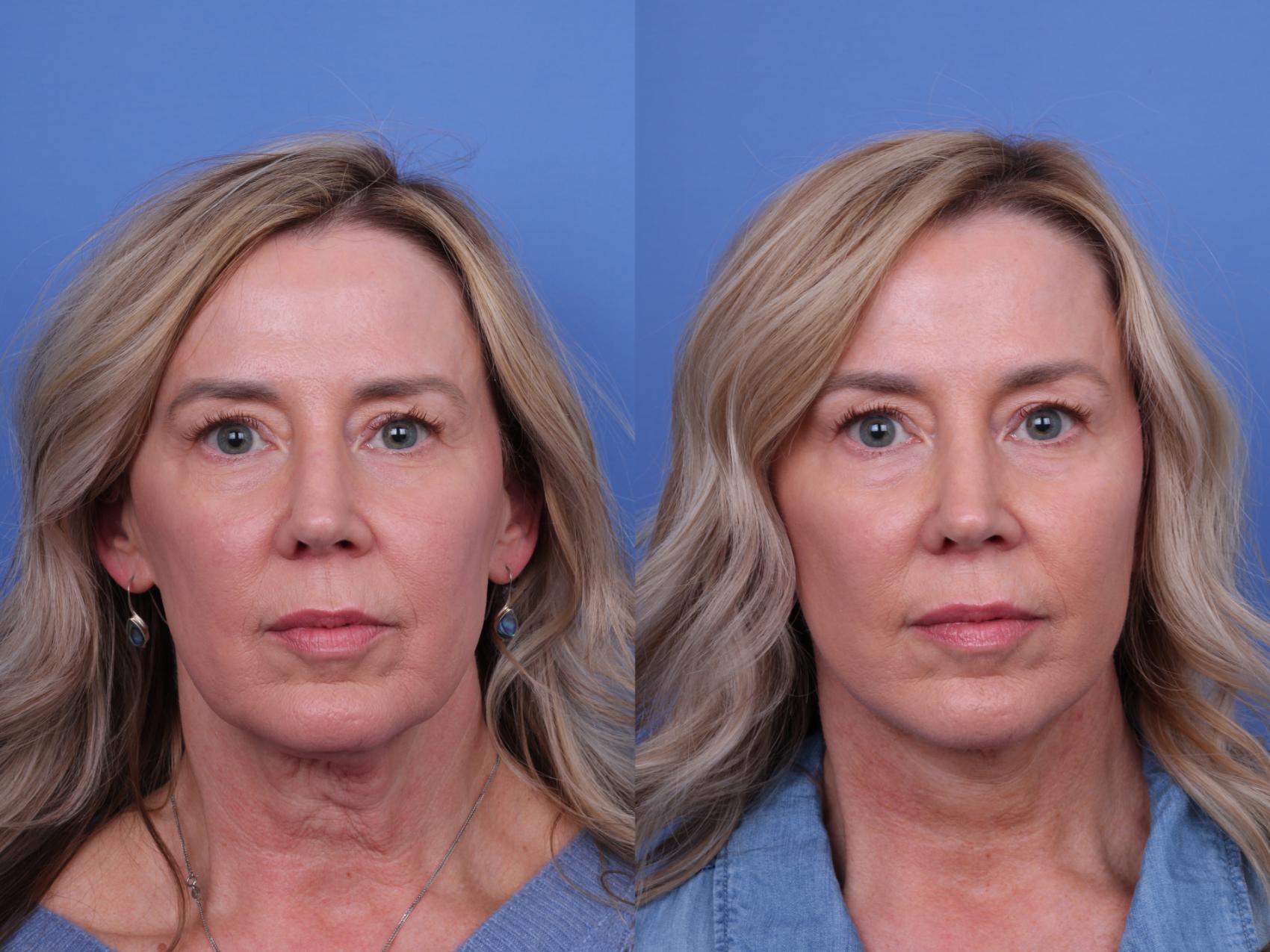 Facelift Before & After Photo | Scottsdale & Phoenix, AZ | Hobgood Facial Plastic Surgery: Todd Hobgood, MD