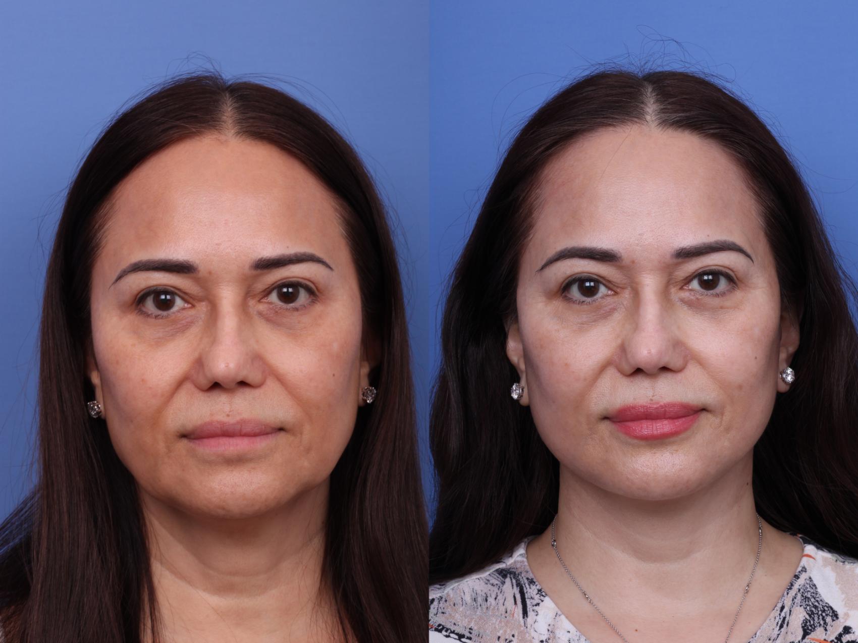 Facelift Before & After Photo | Scottsdale & Phoenix, AZ | Hobgood Facial Plastic Surgery: Todd Hobgood, MD