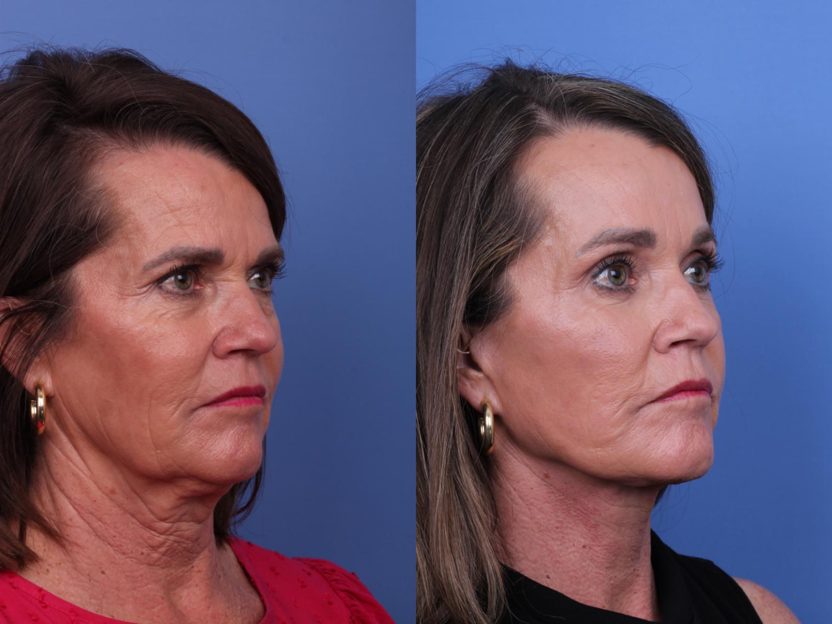 Facelift Before & After Photo | Scottsdale & Phoenix, AZ | Hobgood Facial Plastic Surgery: Todd Hobgood, MD