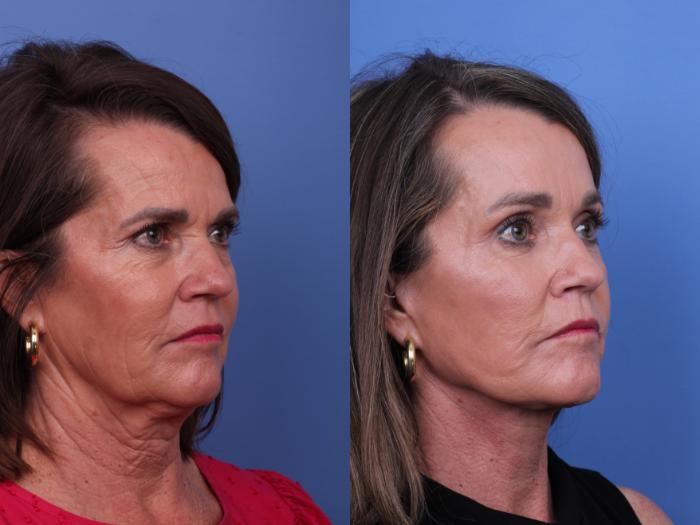 Blepharoplasty Before & After Photo | Scottsdale & Phoenix, AZ | Hobgood Facial Plastic Surgery: Todd Hobgood, MD