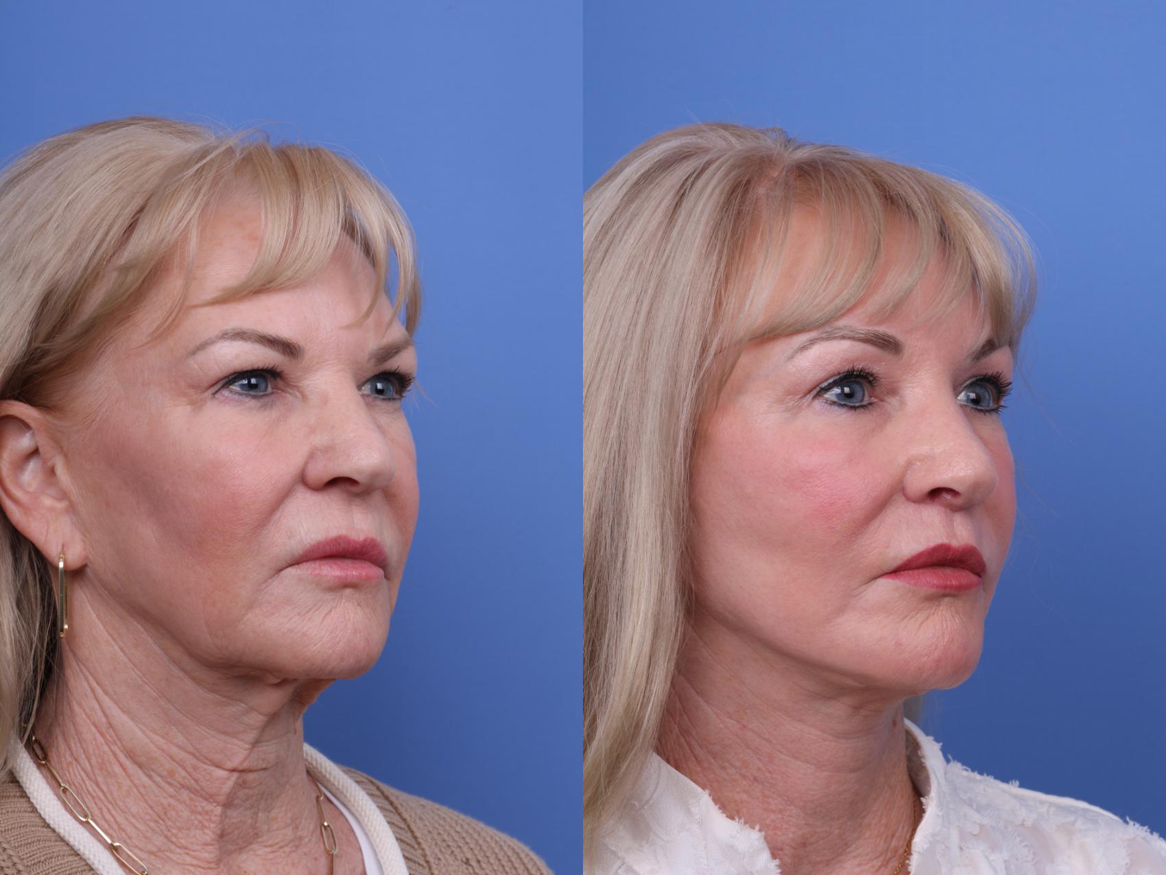 Facelift Before & After Photo | Scottsdale & Phoenix, AZ | Hobgood Facial Plastic Surgery: Todd Hobgood, MD