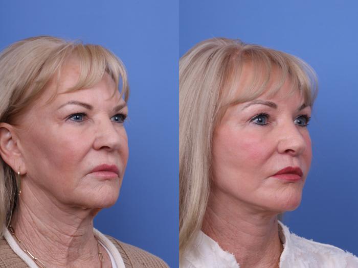 CO2 Laser Resurfacing (under anesthesia) Before & After Photo | Scottsdale & Phoenix, AZ | Hobgood Facial Plastic Surgery: Todd Hobgood, MD