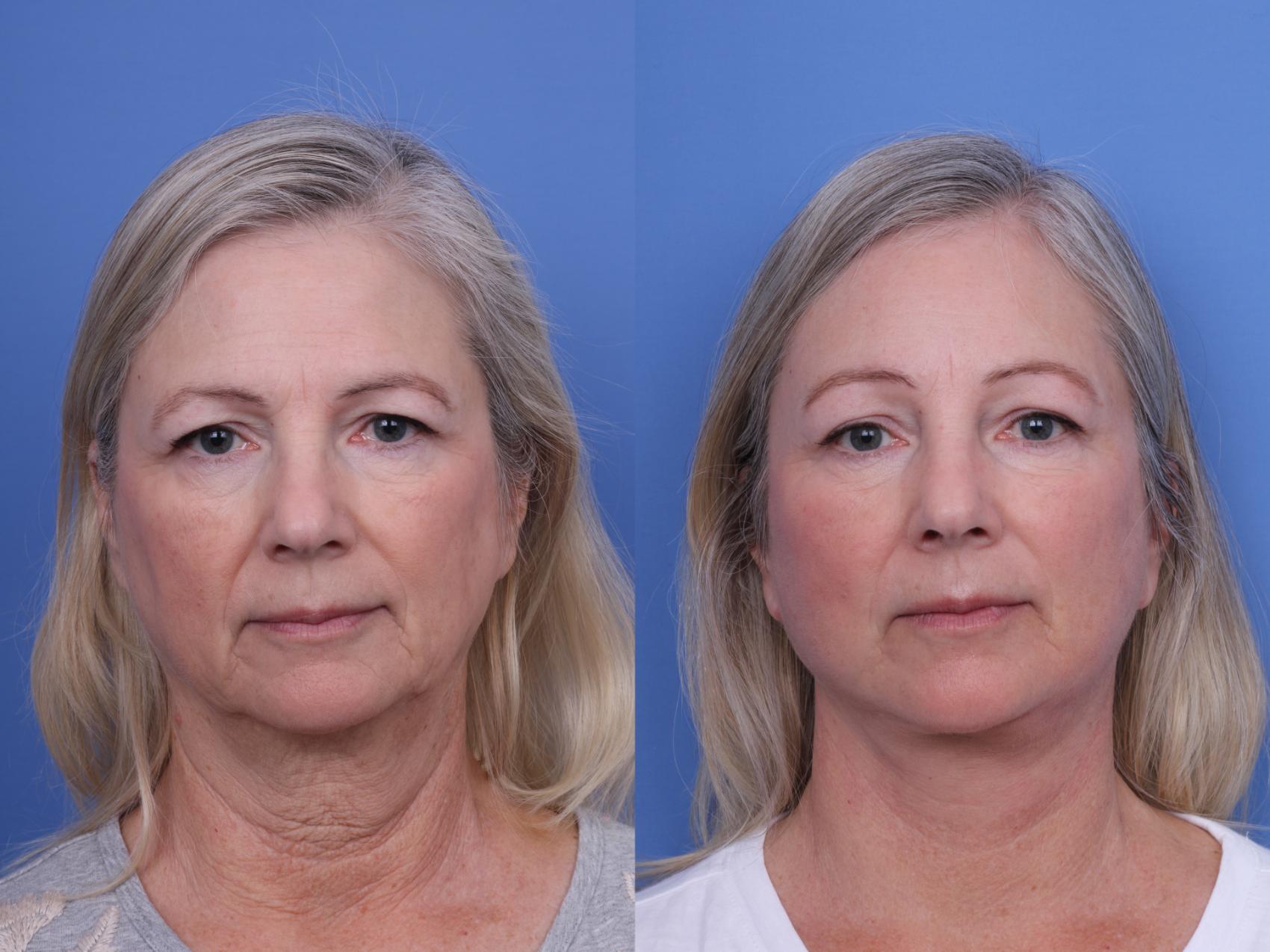 Facelift Before & After Photo | Scottsdale & Phoenix, AZ | Hobgood Facial Plastic Surgery: Todd Hobgood, MD