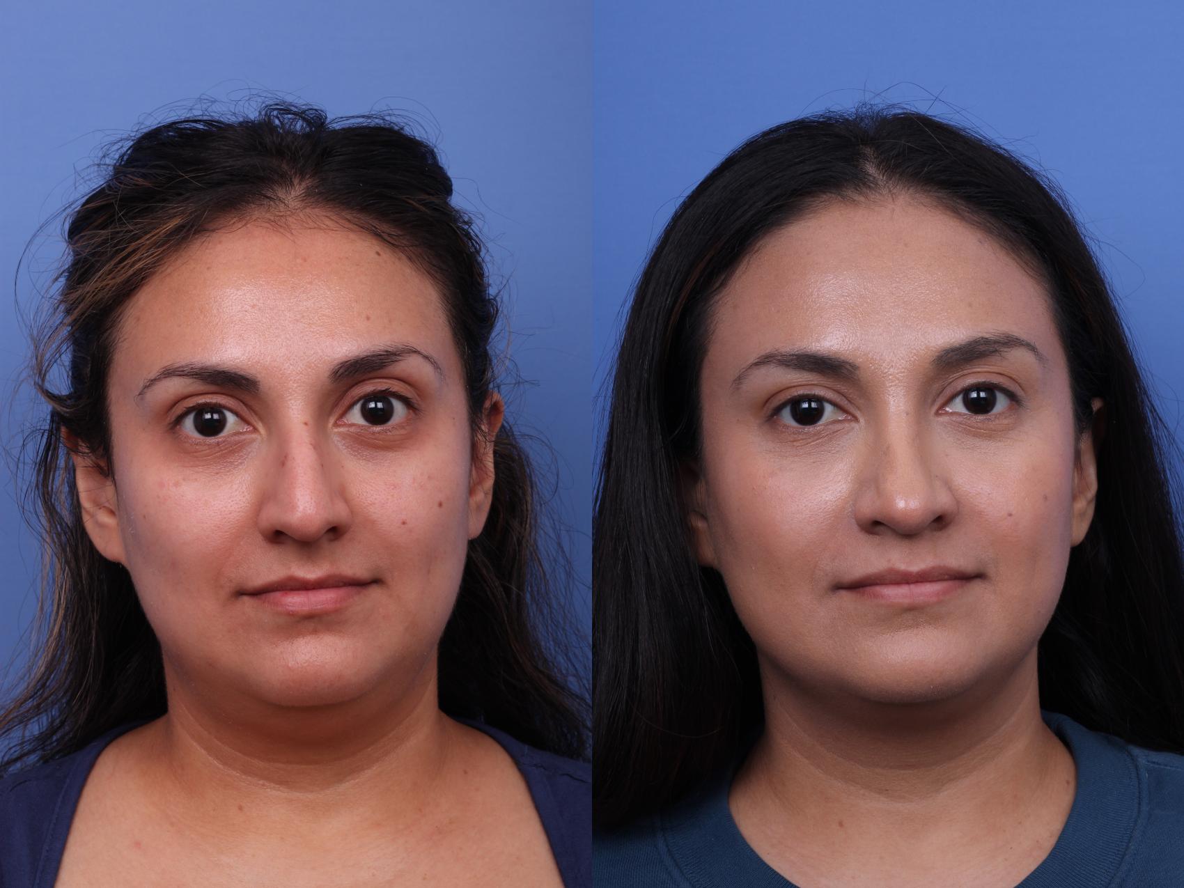 Rhinoplasty Before & After Photo | Scottsdale & Phoenix, AZ | Hobgood Facial Plastic Surgery: Todd Hobgood, MD