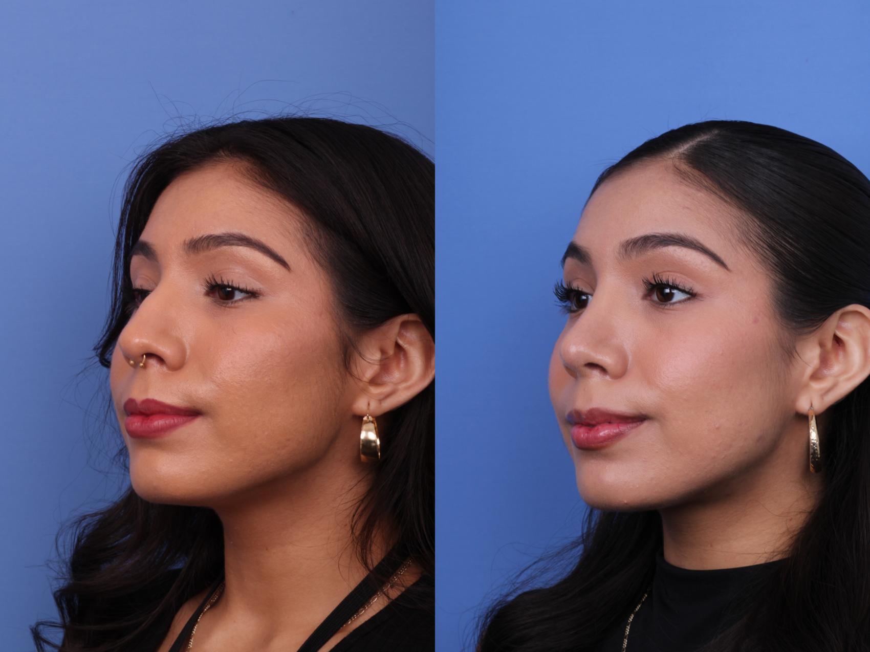 Rhinoplasty Before & After Photo | Scottsdale & Phoenix, AZ | Hobgood Facial Plastic Surgery: Todd Hobgood, MD