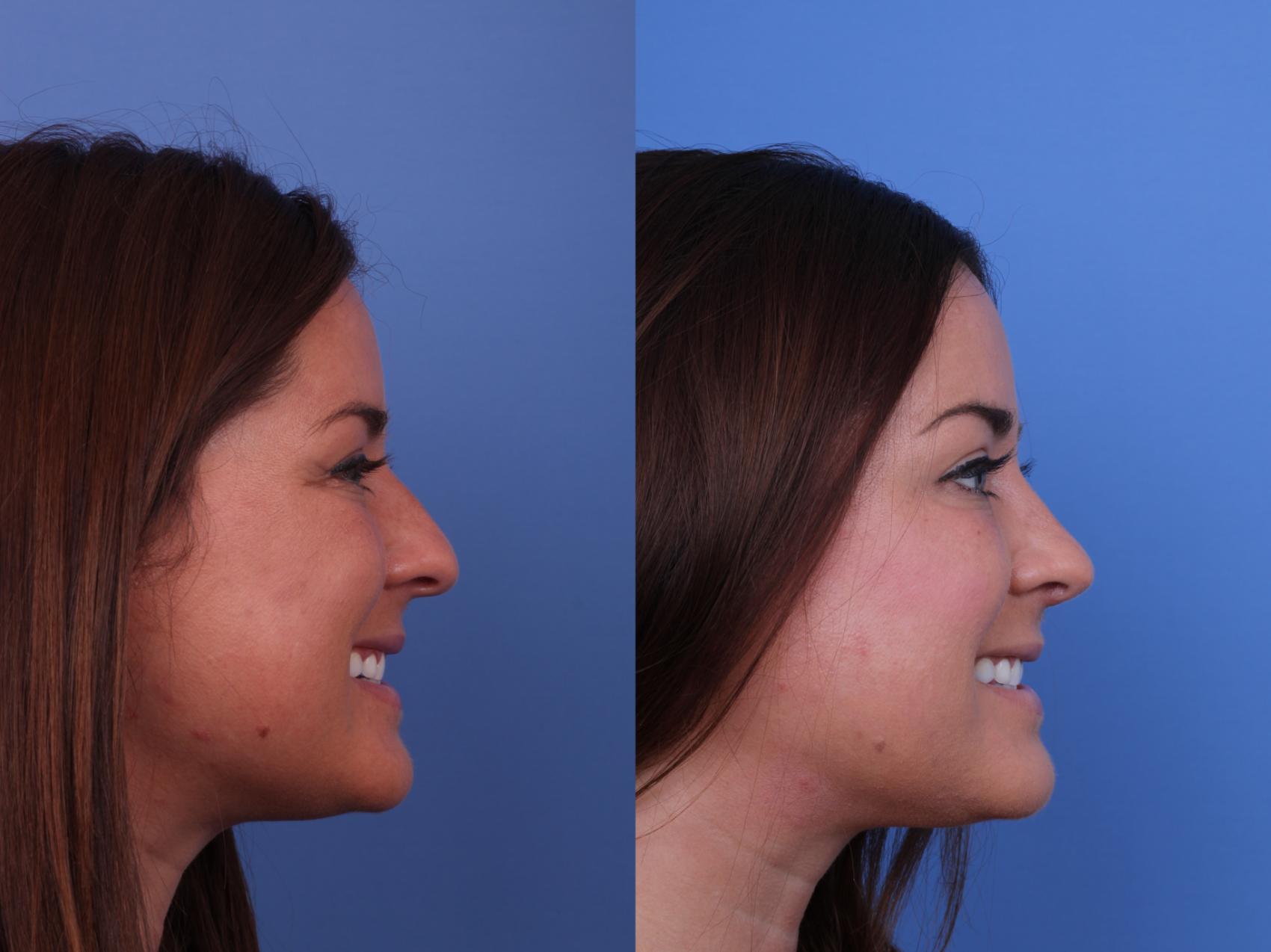 Rhinoplasty Before & After Photo | Scottsdale & Phoenix, AZ | Hobgood Facial Plastic Surgery: Todd Hobgood, MD