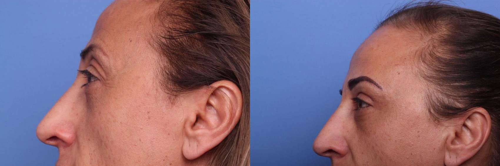 Before & After Blepharoplasty Case 101 View #2 View in Scottsdale, AZ