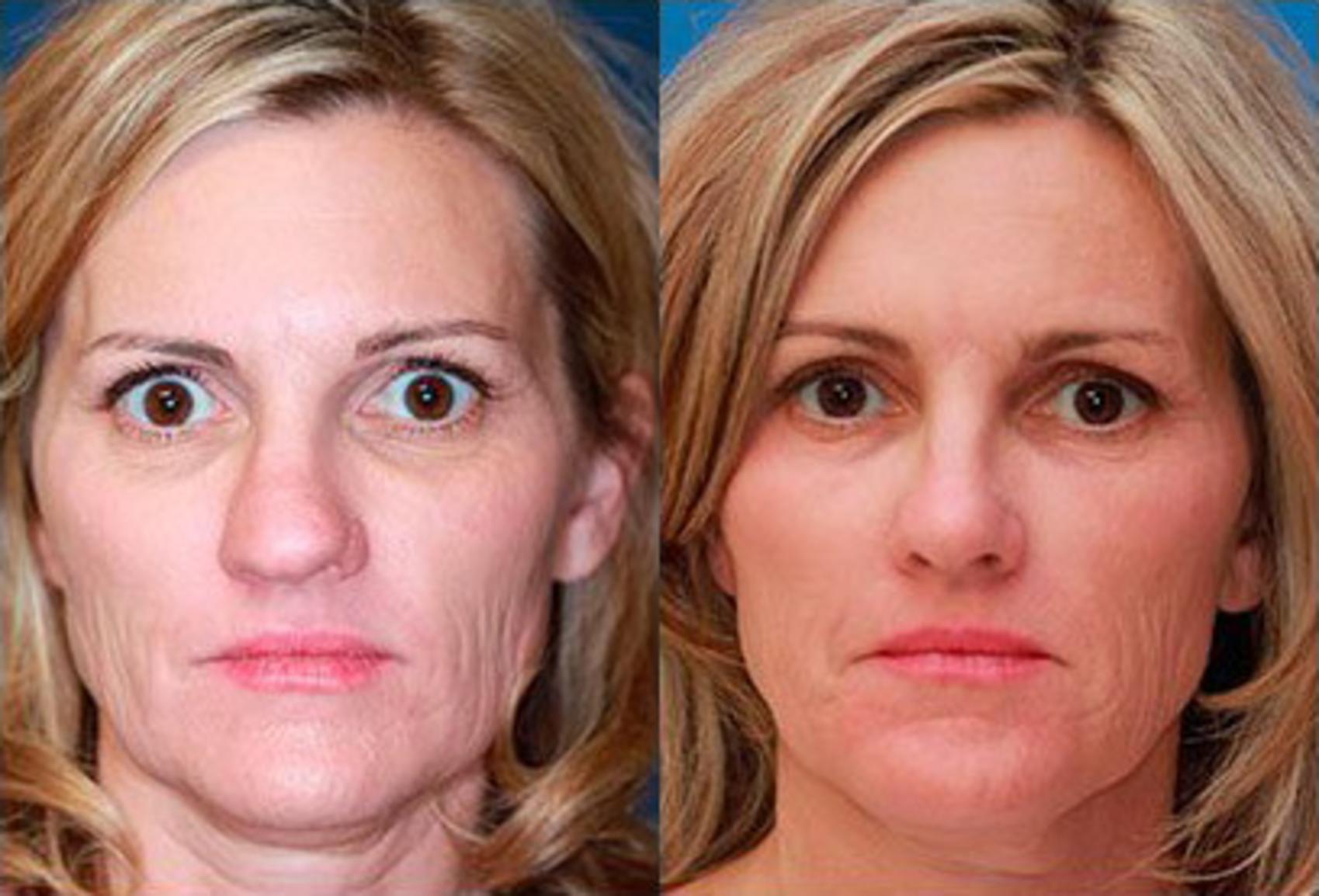 Before & After Blepharoplasty Case 104 View #2 View in Scottsdale, AZ