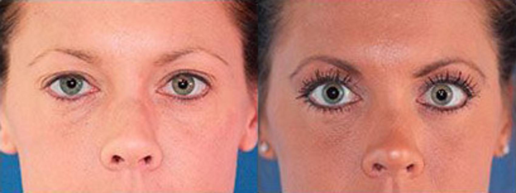 Before & After Blepharoplasty Case 105 View #2 View in Scottsdale, AZ