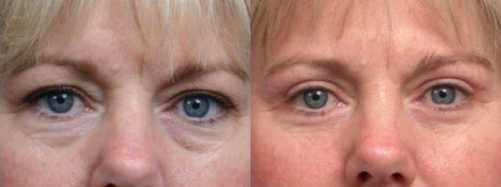 Before & After Blepharoplasty Case 108 View #2 View in Scottsdale, AZ