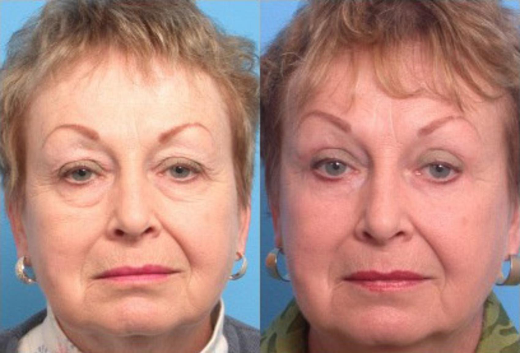 Before & After Blepharoplasty Case 109 View #2 View in Scottsdale, AZ