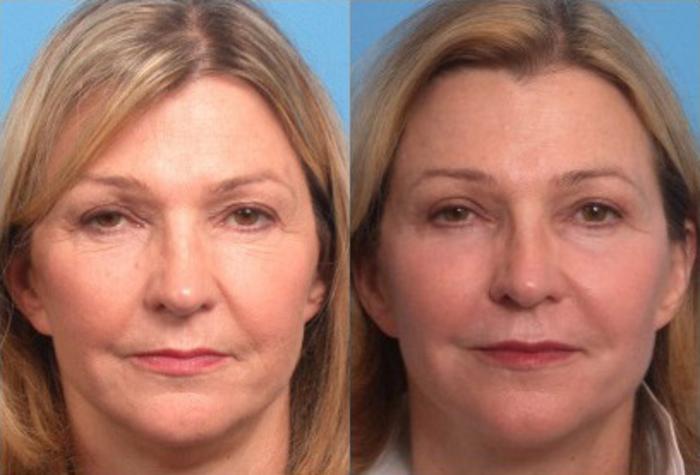 Blepharoplasty Before & After Photo | Scottsdale, AZ | Hobgood Facial Plastic Surgery: Todd Hobgood, MD