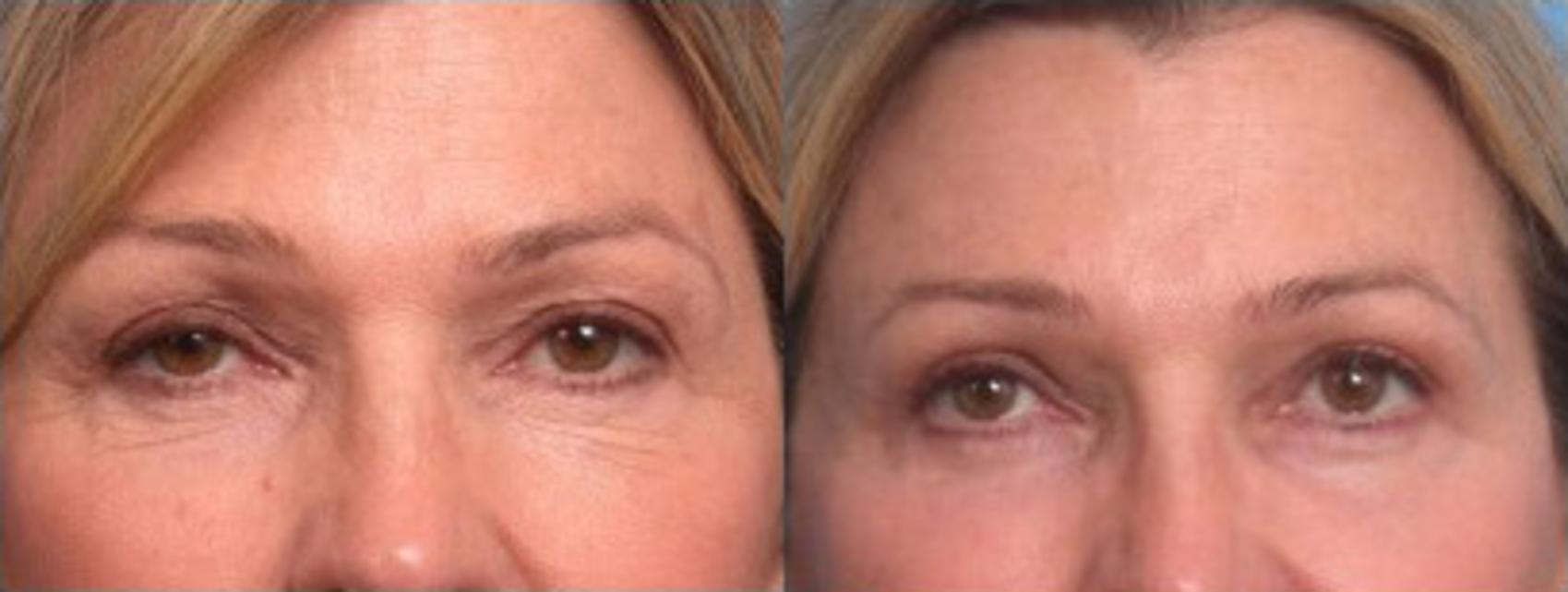 Before & After Blepharoplasty Case 110 View #2 View in Scottsdale, AZ