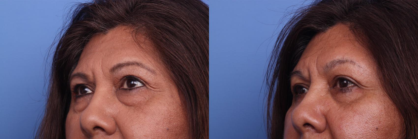 Before & After Blepharoplasty Case 130 View #2 View in Scottsdale, AZ