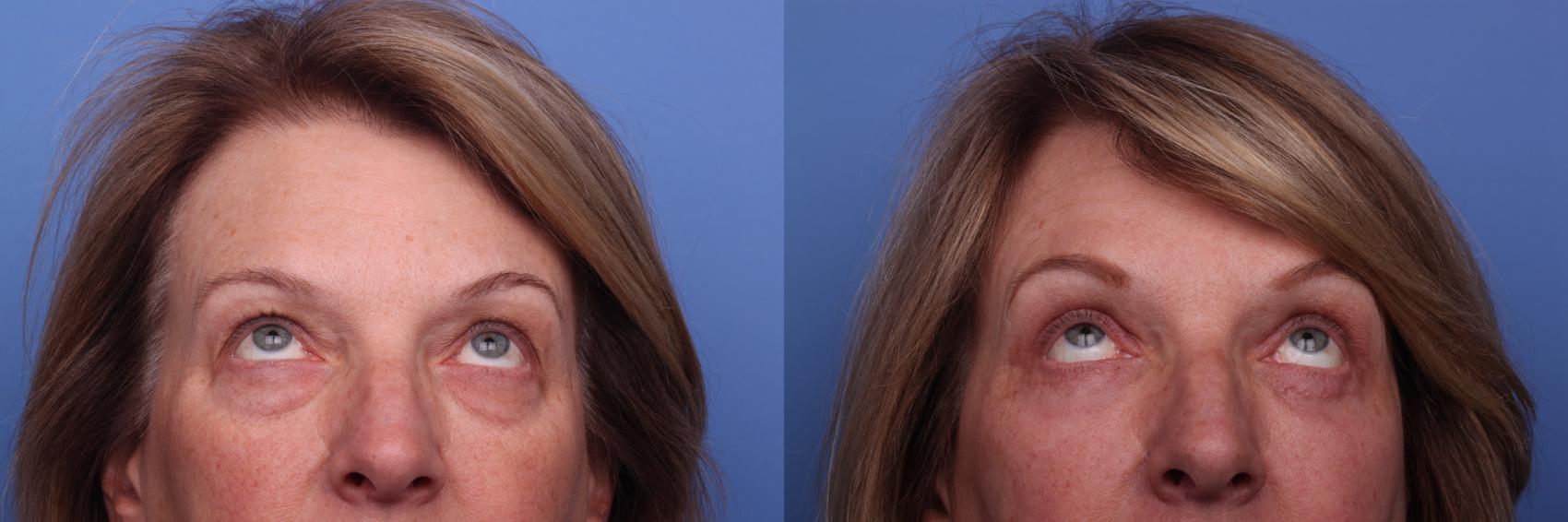 Before & After Blepharoplasty Case 141 View #3 View in Scottsdale, AZ