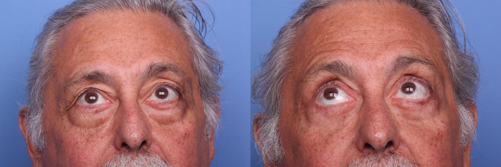 Before & After Blepharoplasty Case 150 View #2 View in Scottsdale, AZ