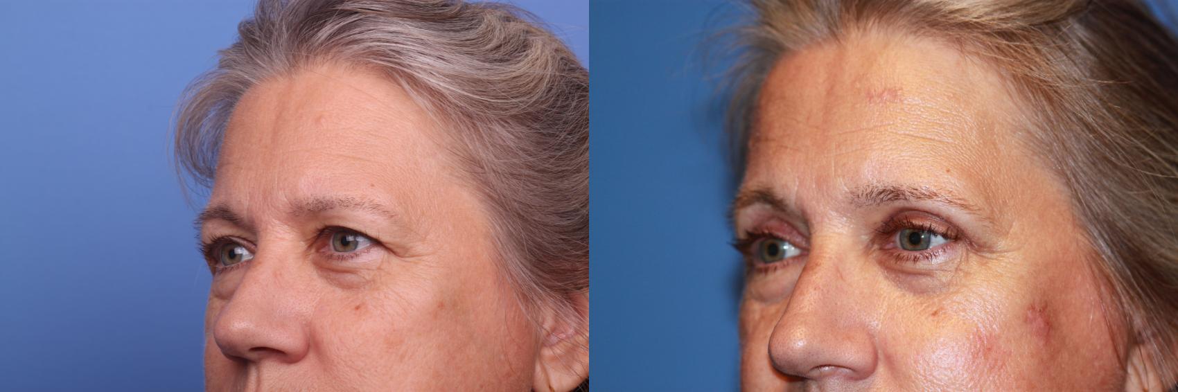 Before & After Blepharoplasty Case 163 View #2 View in Scottsdale, AZ