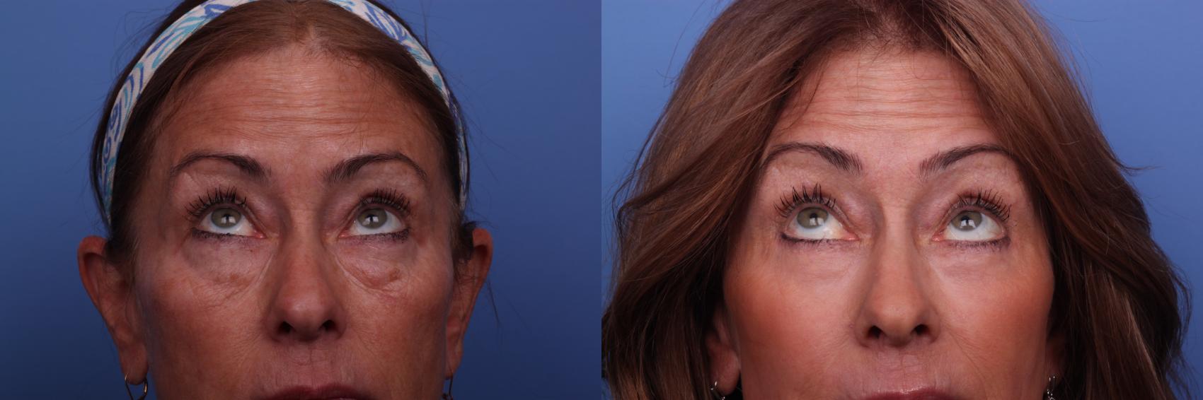 Before & After Blepharoplasty Case 262 View #2 View in Scottsdale, AZ
