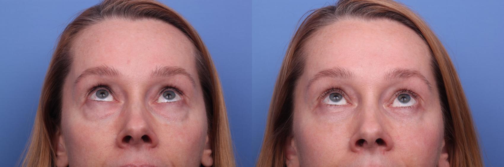 Before & After Blepharoplasty Case 265 View #2 View in Scottsdale, AZ