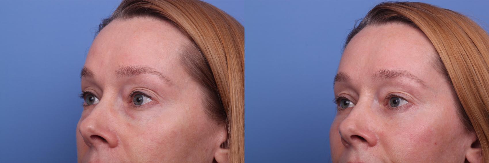 Before & After Blepharoplasty Case 265 View #3 View in Scottsdale, AZ