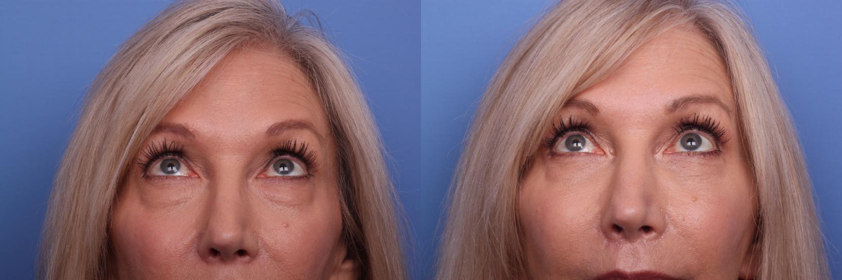 Before & After Blepharoplasty Case 268 View #2 View in Scottsdale, AZ