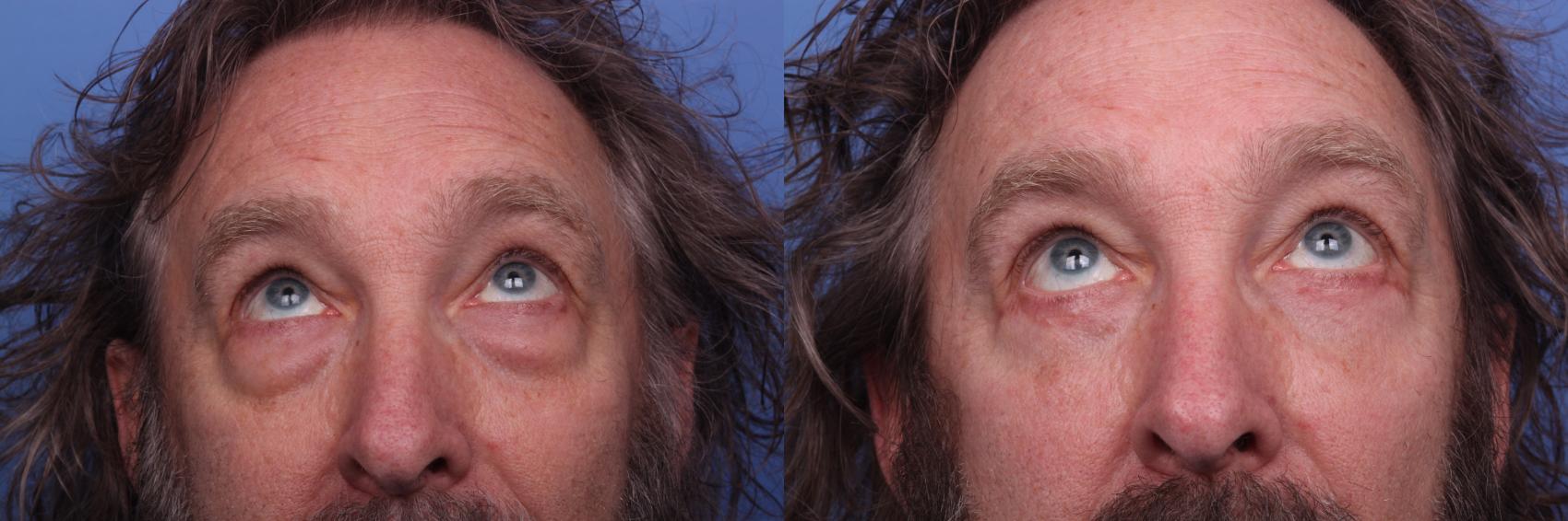 Before & After Blepharoplasty Case 296 View #3 View in Scottsdale, AZ