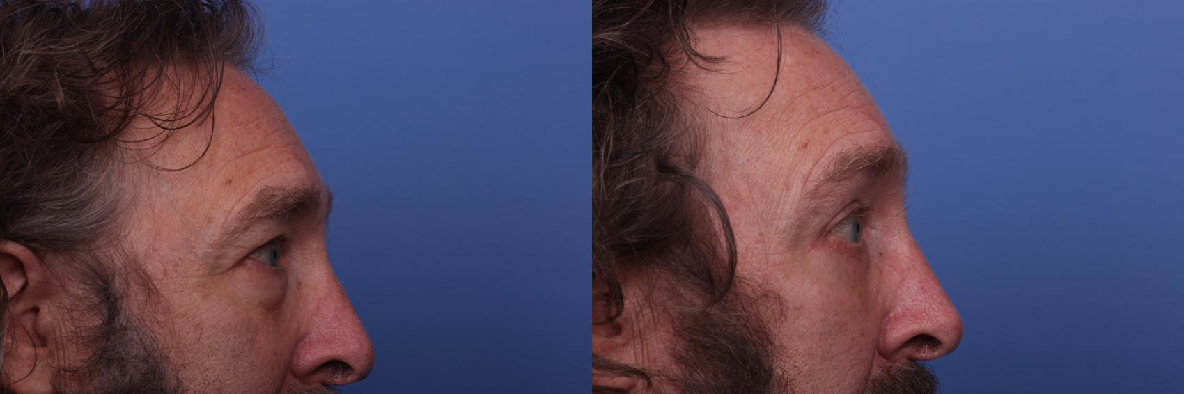 Before & After Blepharoplasty Case 296 View #4 View in Scottsdale, AZ