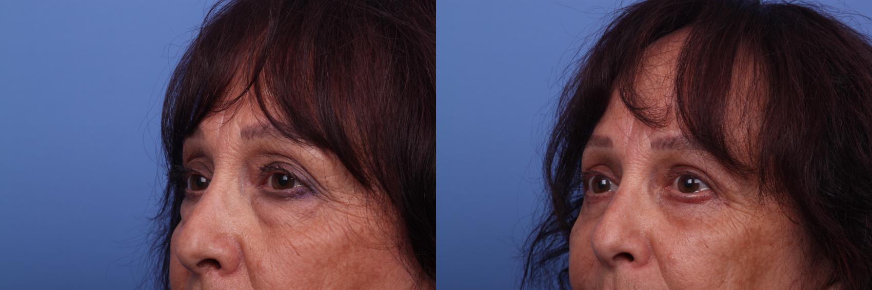 Before & After Blepharoplasty Case 320 View #2 View in Scottsdale, AZ