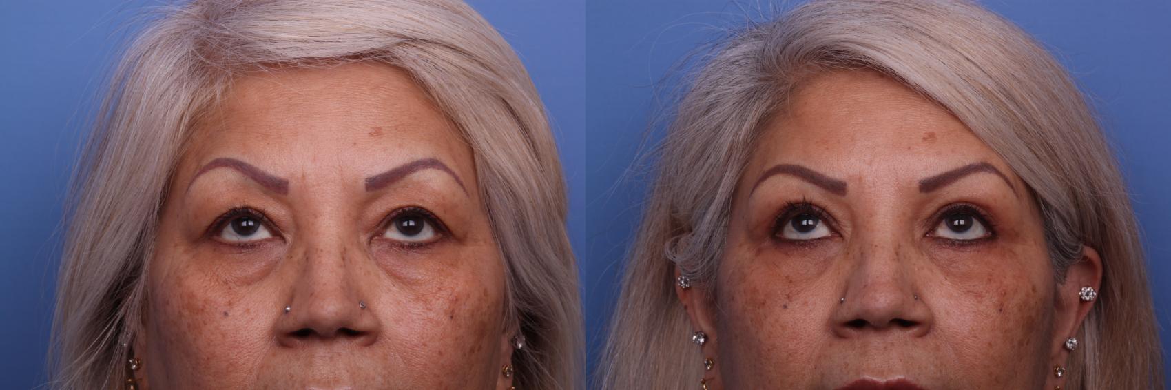 Before & After Blepharoplasty Case 326 View #2 View in Scottsdale, AZ