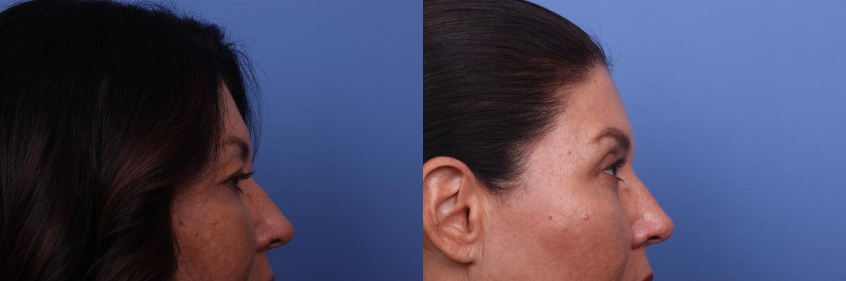 Before & After Blepharoplasty Case 334 View #2 View in Scottsdale, AZ