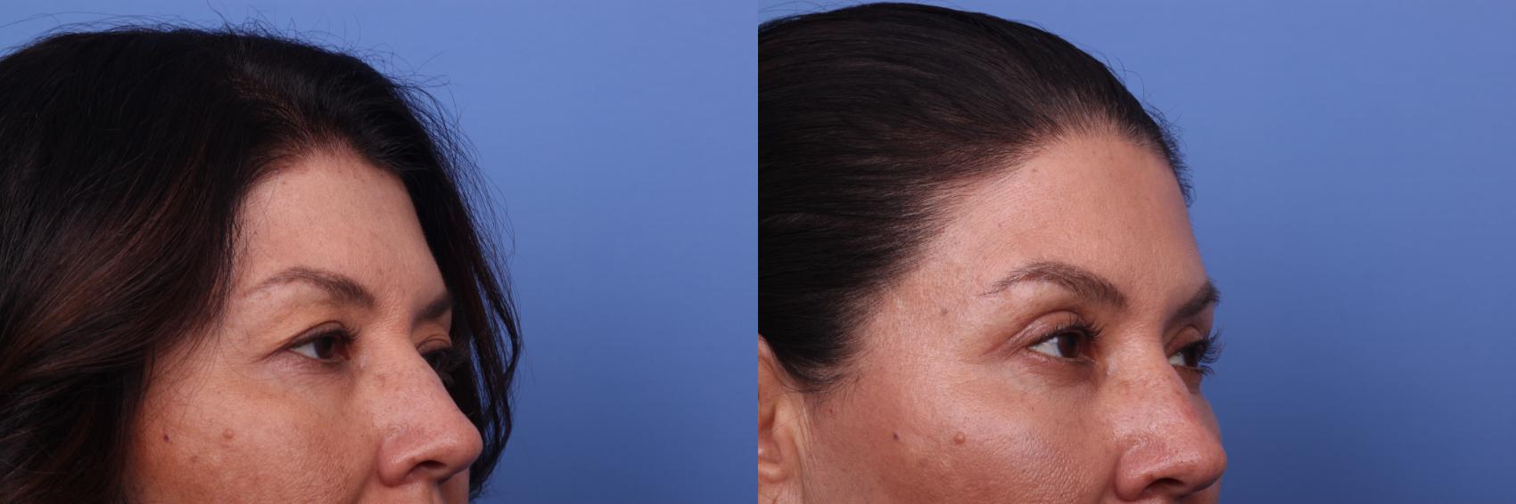 Before & After Blepharoplasty Case 334 View #3 View in Scottsdale, AZ