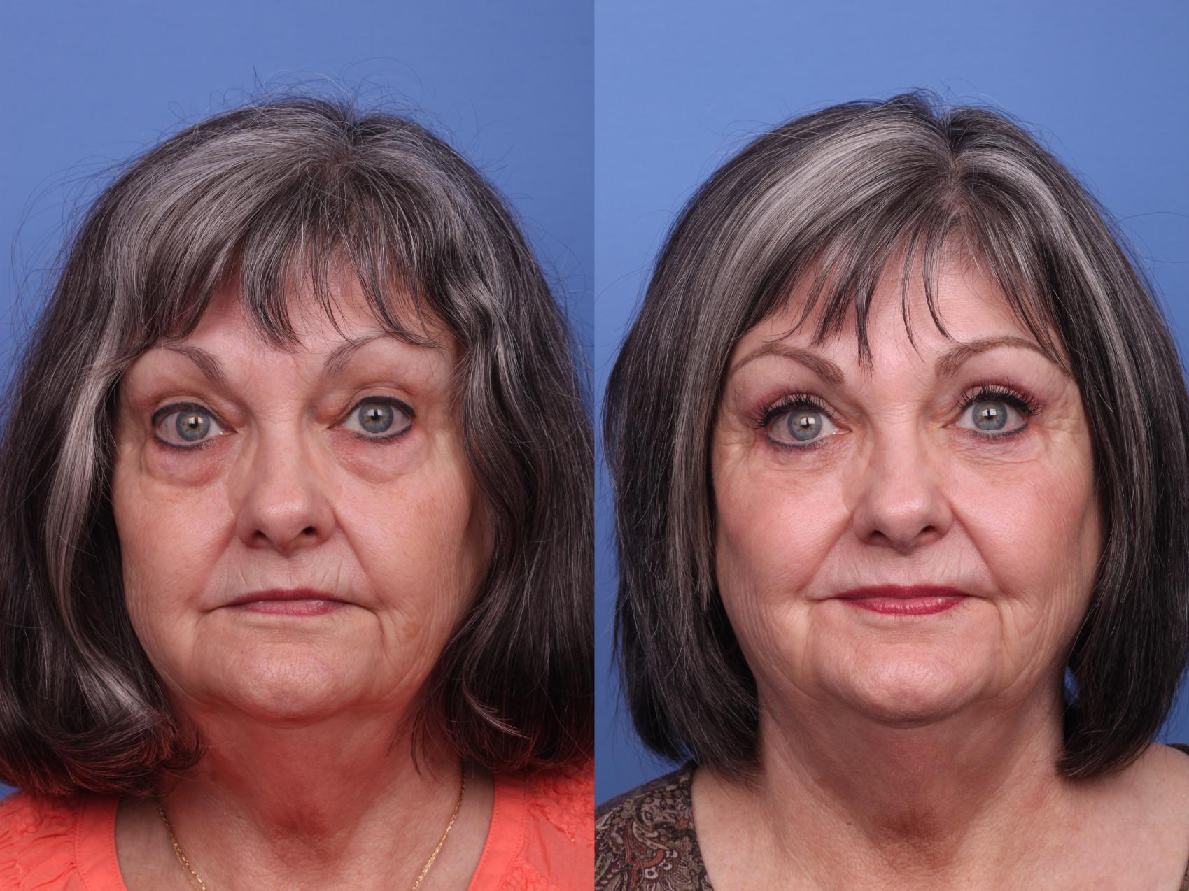 blepharoplasty-before-and-after-pictures-case-386-scottsdale