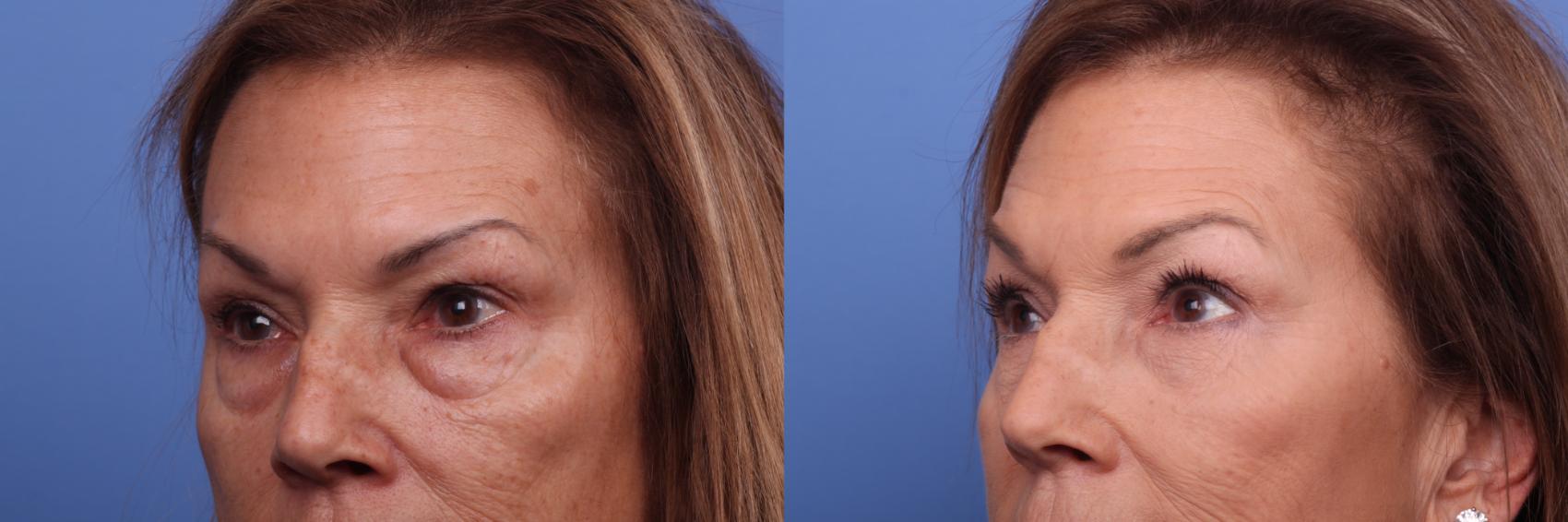 Before & After Blepharoplasty Case 387 Left Oblique View in Scottsdale, AZ