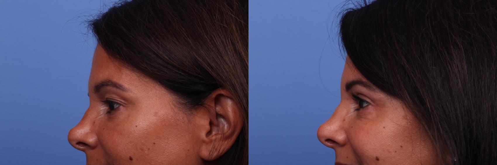 Before & After Blepharoplasty Case 389 Left Side View in Scottsdale, AZ