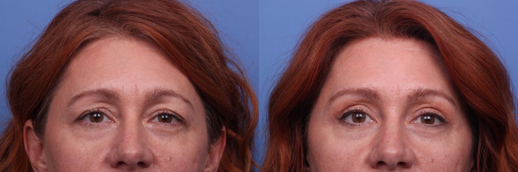 Before & After Blepharoplasty Case 390 Front View in Scottsdale, AZ