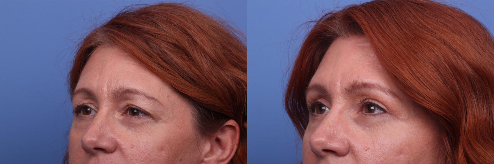 Before & After Blepharoplasty Case 390 Left Oblique View in Scottsdale, AZ