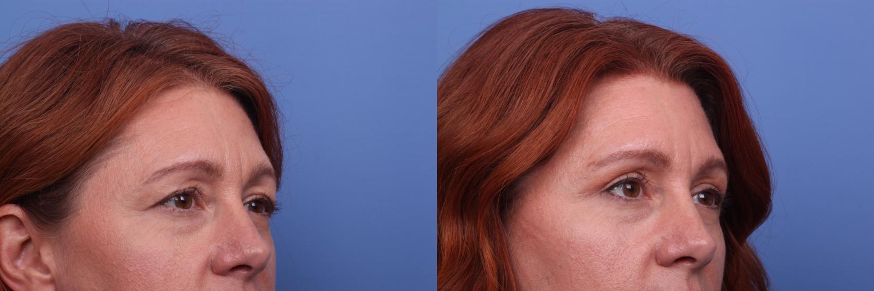 Blepharoplasty Before And After Pictures Case 390 Scottsdale And Phoenix Az Hobgood Facial 