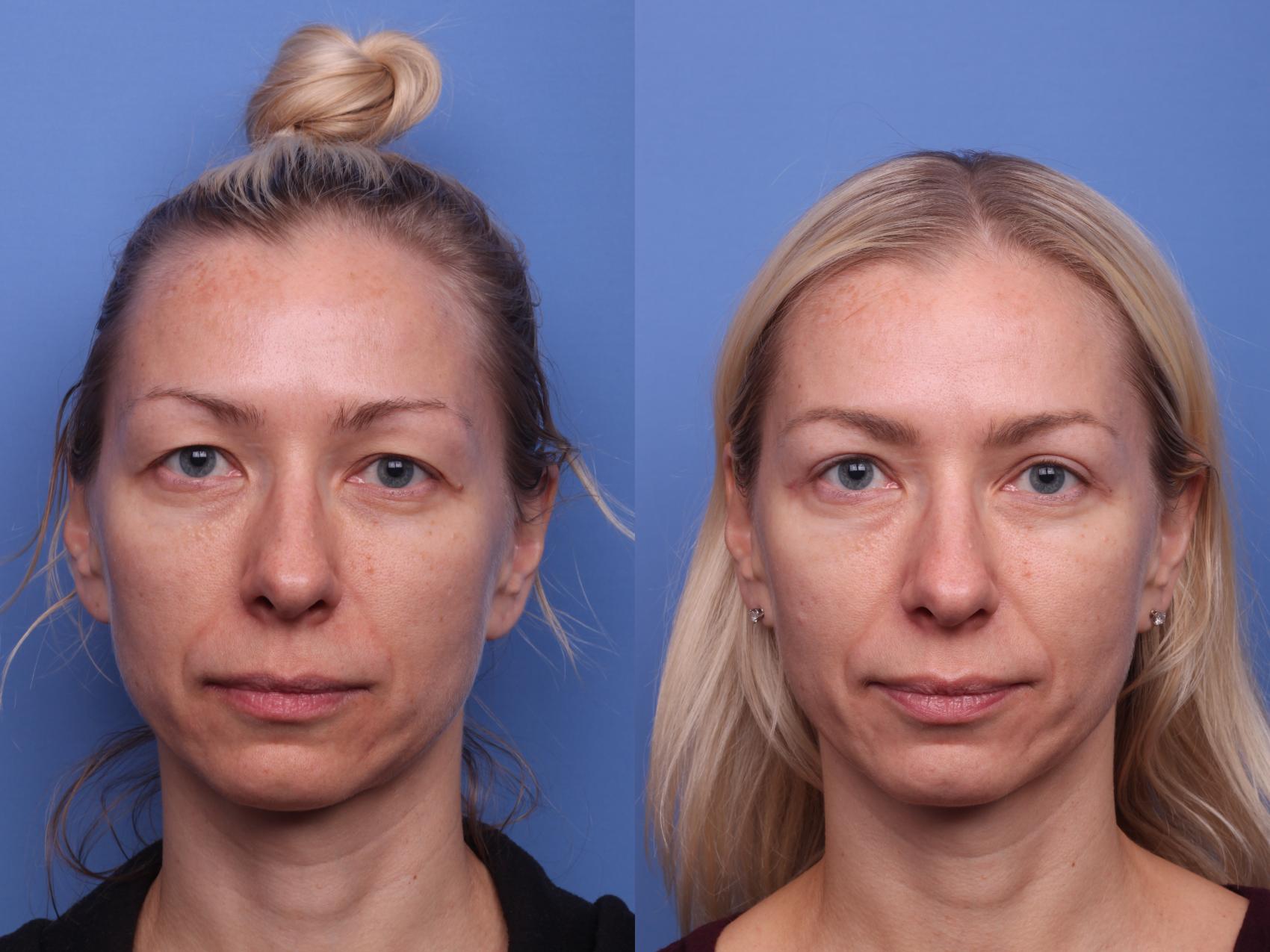 Before & After Blepharoplasty Case 444 Front View in Scottsdale, AZ