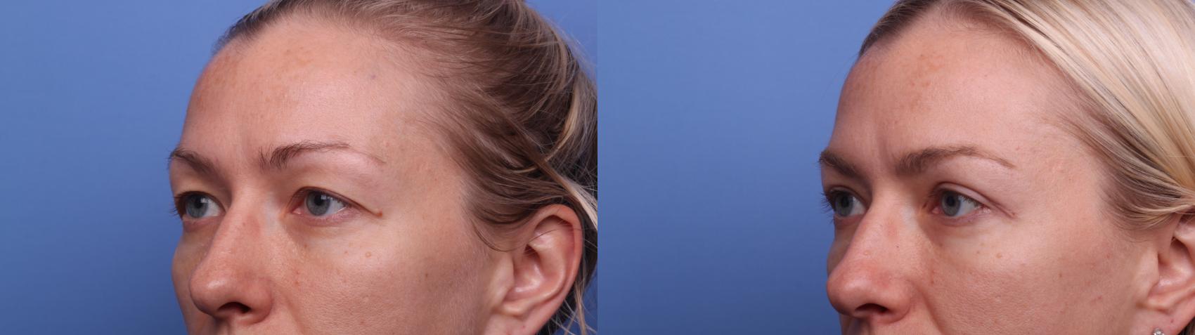 Before & After Blepharoplasty Case 444 Left Oblique View in Scottsdale, AZ