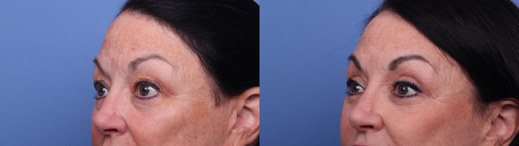 Before & After Blepharoplasty Case 445 Left Oblique View in Scottsdale, AZ