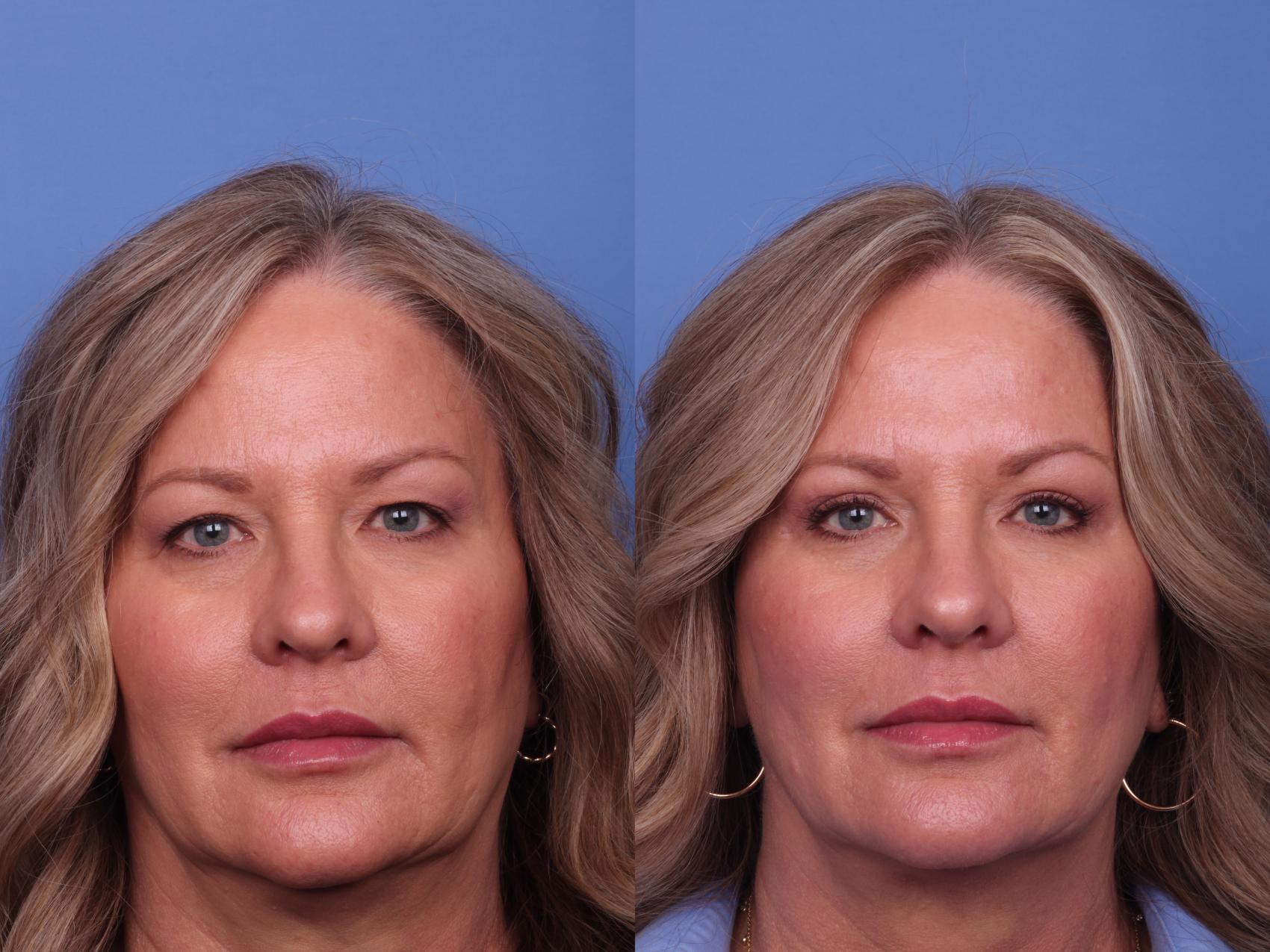 Before & After Blepharoplasty Case 452 Front View in Scottsdale, AZ